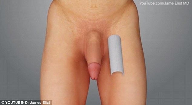 The implant (pictured) spans the length of the penis, and also wraps 270 degrees around the member. It is inserted through a small incision made above the groin